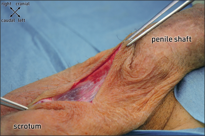 Penis before and after circumcision - Mayo Clinic