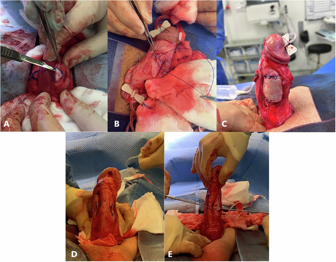 before and after topical l carnitine on penile glans HCG supplement did not accelerate tunica albuginea remodeling to facilitate growth Some health issues are hard