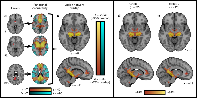 Semantic memory deficits are associated with pica in individuals with  acquired brain injury - ScienceDirect