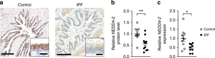 Conditional deletion of nedd4-2 in lung epithelial cells causes progressive pulmonary fibrosis in adult mice