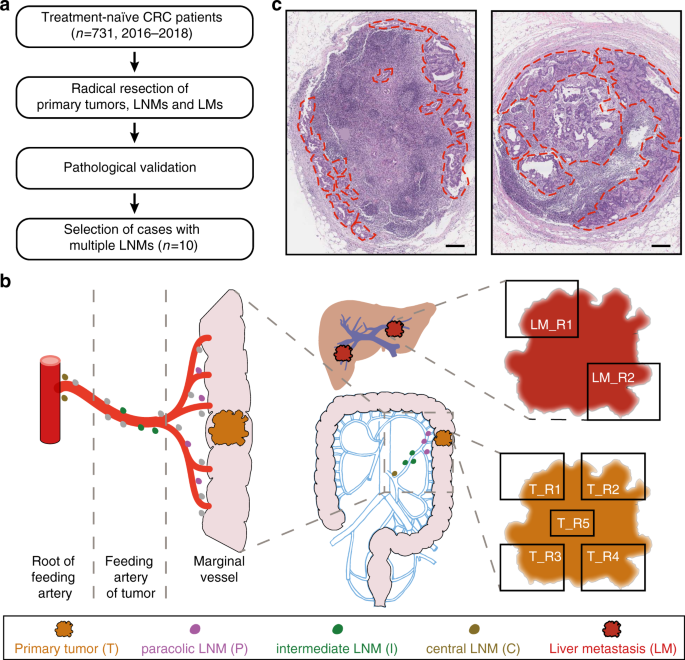 Mapping The Spreading Routes Of Lymphatic Metastases In Human Colorectal  Cancer | Nature Communications