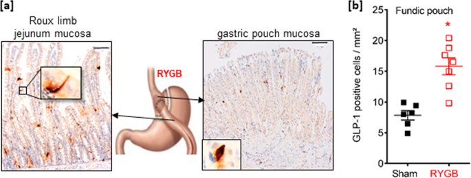 Esophagus-duodenum Gastric Bypass Surgery Improves Glucose and Lipid  Metabolism in Mice - eBioMedicine