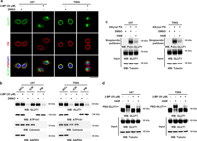 DHHC9-mediated GLUT1 S-palmitoylation promotes glioblastoma glycolysis and tumorigenesis