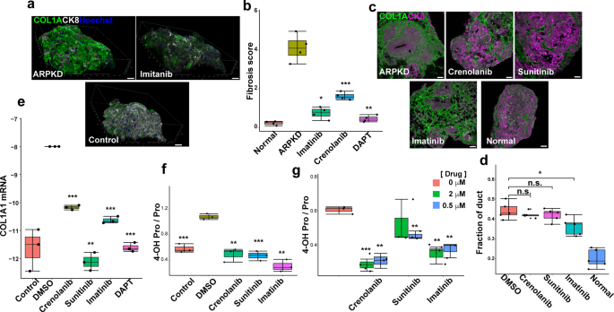 A human multi-lineage hepatic organoid model for liver fibrosis