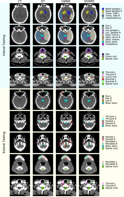Impact of Neuroradiology-Based Peer Review on Head and Neck Radiotherapy  Target Delineation