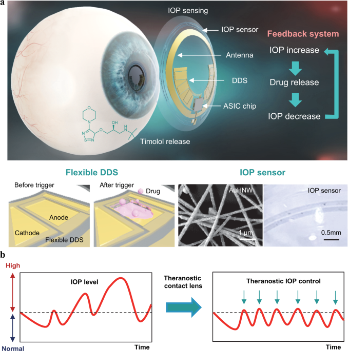 Wireless theranostic smart contact lens for monitoring and control