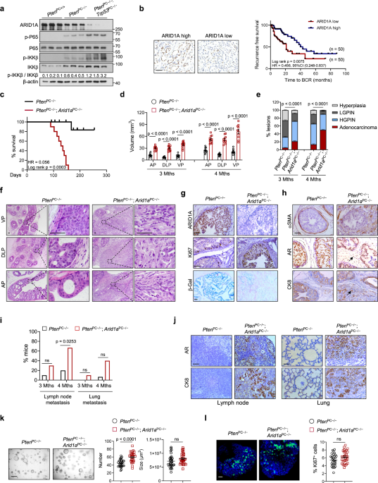 Arid1a loss induces polymorphonuclear myeloid-derived suppressor cell chemotaxis and promotes prostate cancer progression
