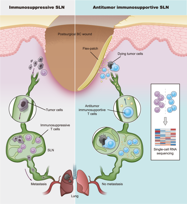 Fueling sentinel node via reshaping cytotoxic T lymphocytes with a flex- patch for post-operative immuno-adjuvant therapy | Nature Communications