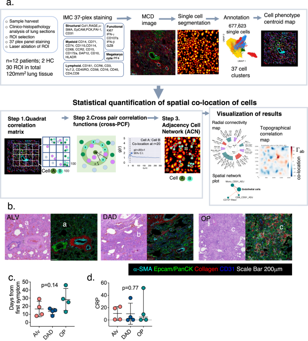 Single cell spatial analysis reveals inflammatory foci of immature 