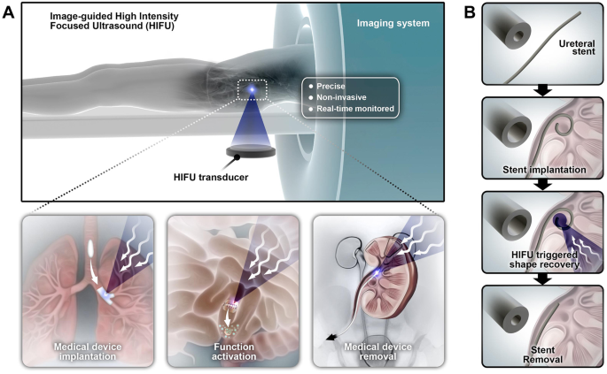 Shape-recovery of implanted shape-memory devices remotely 