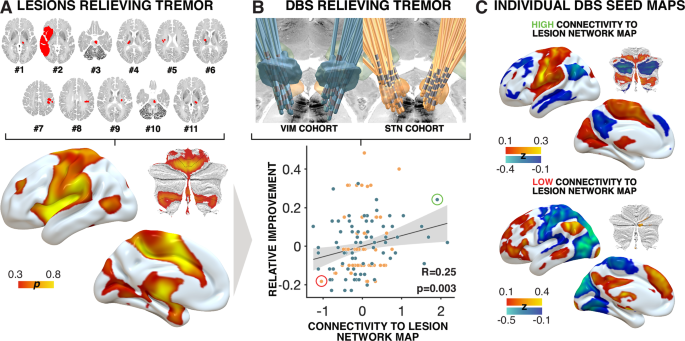 Convergent mapping of a tremor treatment network | Nature Communications