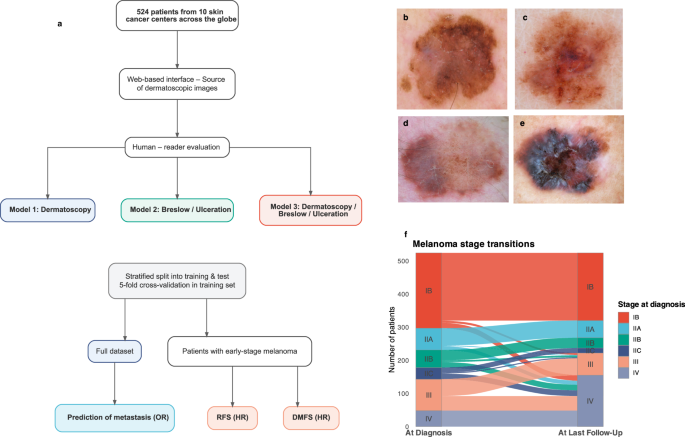 Predictive models of melanoma metastasis based on dermatoscopy in an ...