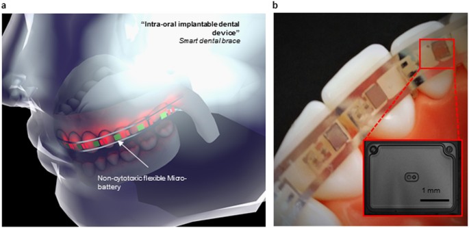 Flexible and biocompatible high-performance solid-state micro-battery for  implantable orthodontic system | npj Flexible Electronics