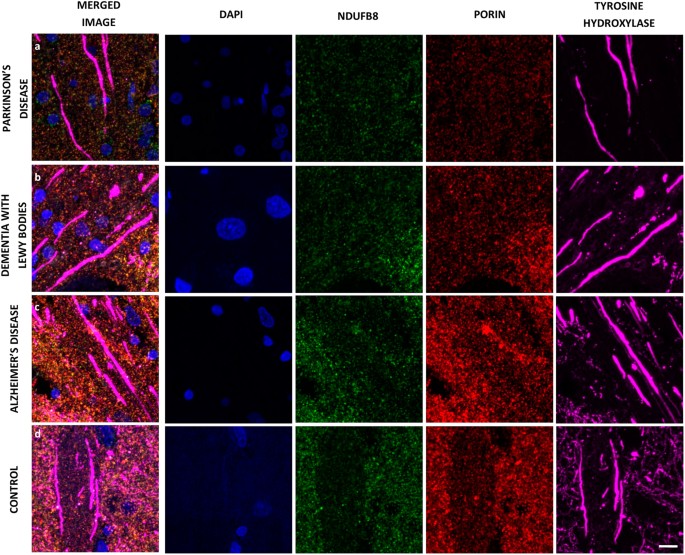 Mitochondrial Deficits In Children With >> Mitochondrial Dysfunction Within The Synapses Of Substantia Nigra Mitochondrial Deficits In Children With >> Mitochondrial Dysfunction Within The Synapses Of Substantia Nigra