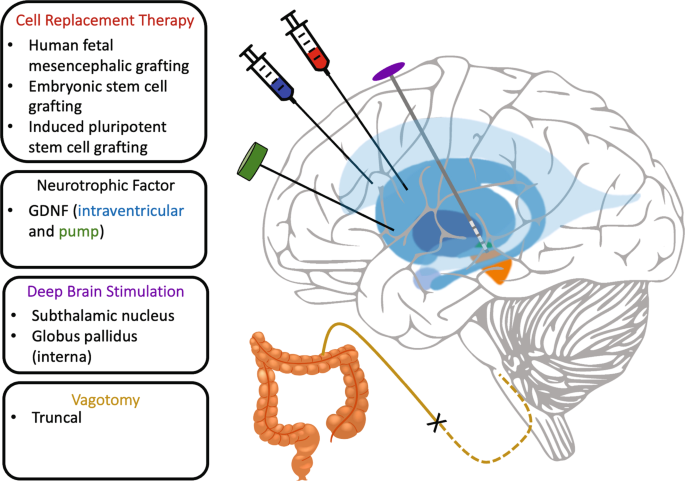 Comparative efficacy of surgical approaches to disease modification in Parkinson  disease
