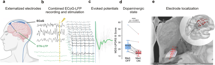 Dopamine amplifies subthalamic long-latency responses to cortical stimulation in patients with Parkinson’s disease