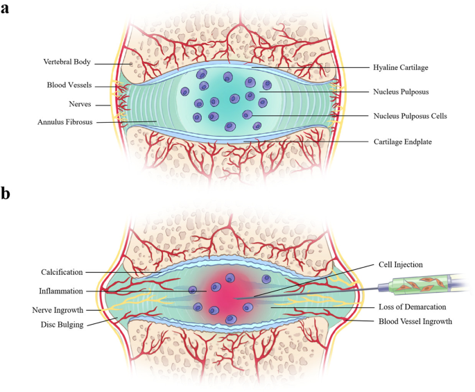 The Aging Spine and Degenerative Disc Disease