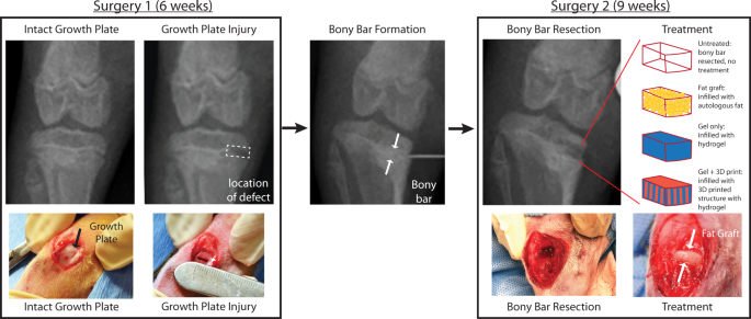 A 3D printed mimetic composite for the treatment of growth plate injuries  in a rabbit model | npj Regenerative Medicine
