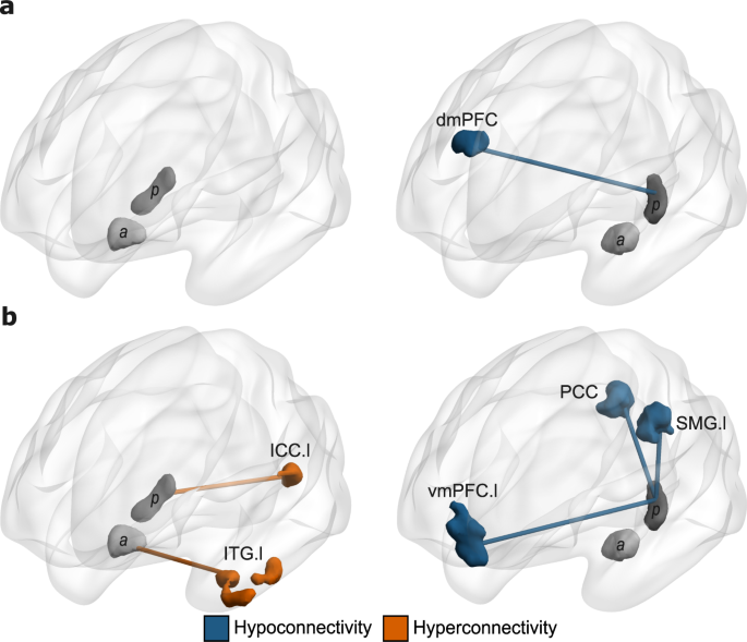 Functional Connectivity Abnormalities Of The Long Axis Hippocampal Subregions In Schizophrenia During Episodic Memory Npj Schizophrenia