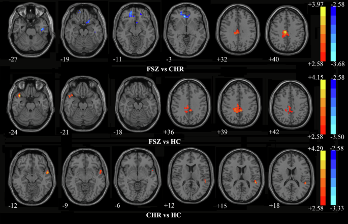 Abnormal eye movement, brain regional homogeneity in schizophrenia and ...