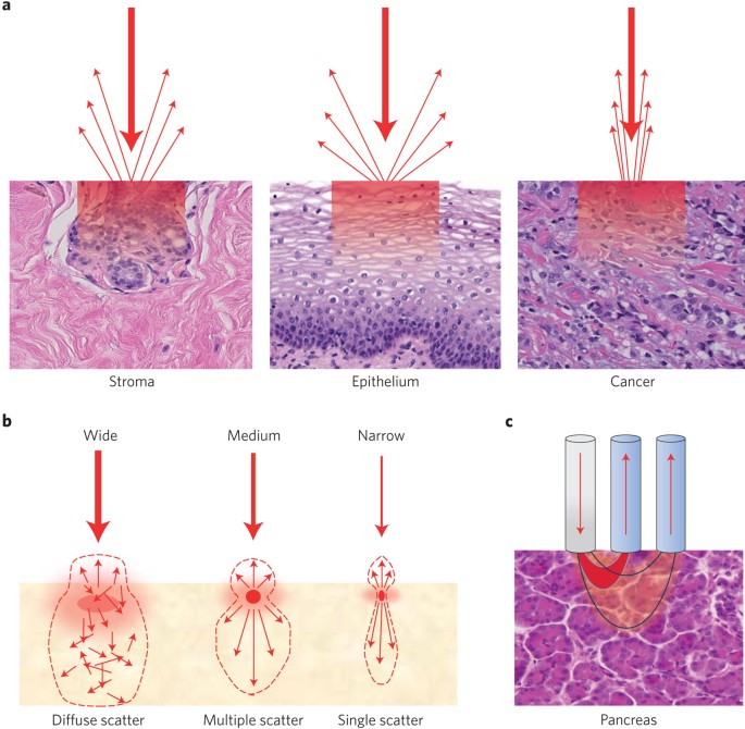 Cancer diagnostics: Light scattering by pancreatic cysts | Nature  Biomedical Engineering