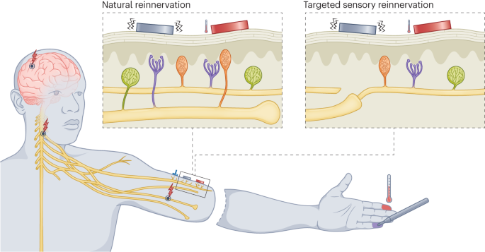 Thermally sentient bionic limbs