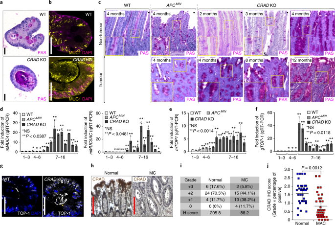 Deregulation Of Crad Controlled Cytoskeleton Initiates Mucinous A B Excessive Mucin Deposition In Crad Ko Induced Cystic Spheroids Pas Staining And Ihc Of Muc1 Was Performed On Organoids From Wt