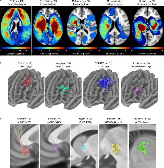 Brain stimulation and brain lesions converge on common causal circuits in neuropsychiatric disease