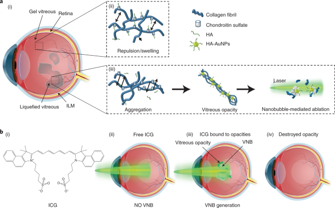 Laser-induced nanobubbles safely ablate vitreous opacities in vivo | Nature  Nanotechnology