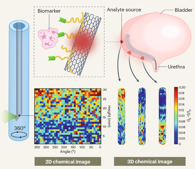 Nanosensor-coated catheters for bladder cancer detection Nanosensor-coated catheters for bladder cancer detection