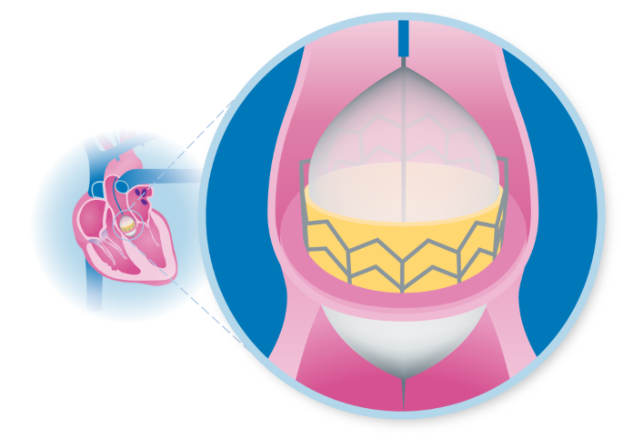 Tavr versus surgery in low-risk patients