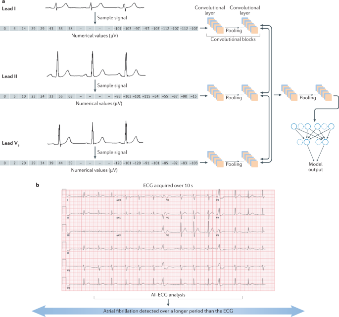 Artificial intelligence-enhanced electrocardiography in cardiovascular  disease management | Nature Reviews Cardiology