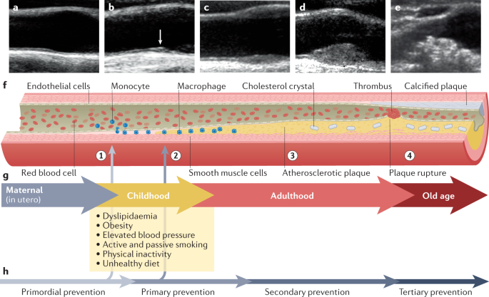 Atherosclerosis - What Is Atherosclerosis?