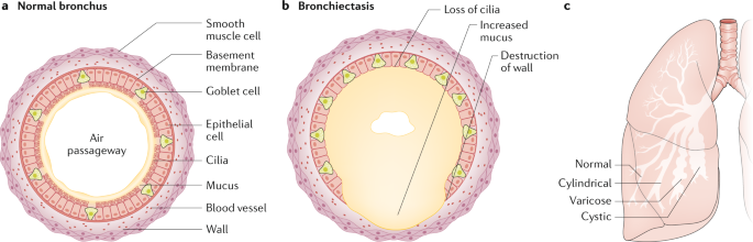 types of bronchiectasis