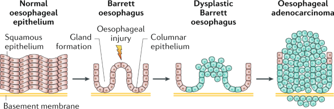 Barrett oesophagus | Nature Reviews Disease Primers
