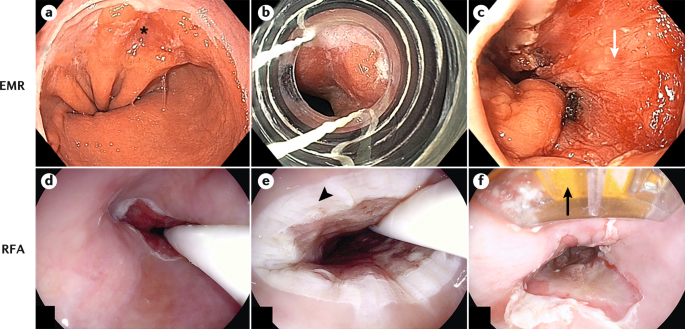 Cureus  Barrett's Esophagus in Rubinstein-Taybi Syndrome