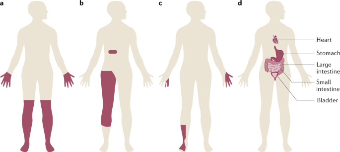 diabetic polyneuropathy)