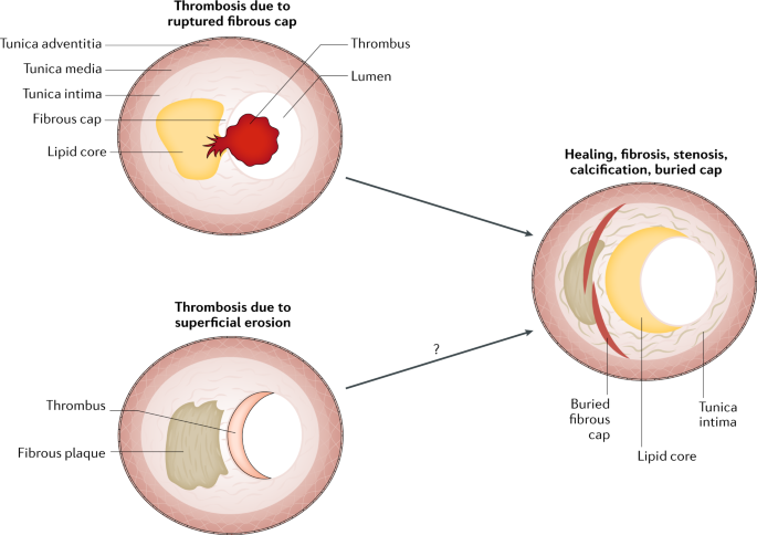 Frontiers  Characteristics and evaluation of atherosclerotic plaques: an  overview of state-of-the-art techniques