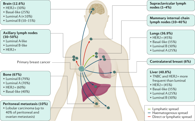 Breast cancer  Nature Reviews Disease Primers