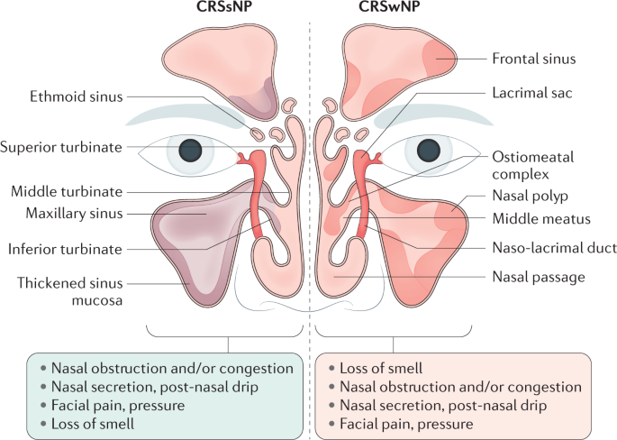 Adult Chronic Rhinosinusitis Nature Reviews Disease Primers