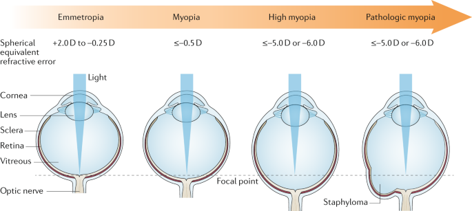 Myopia | Nature Reviews Disease Primers