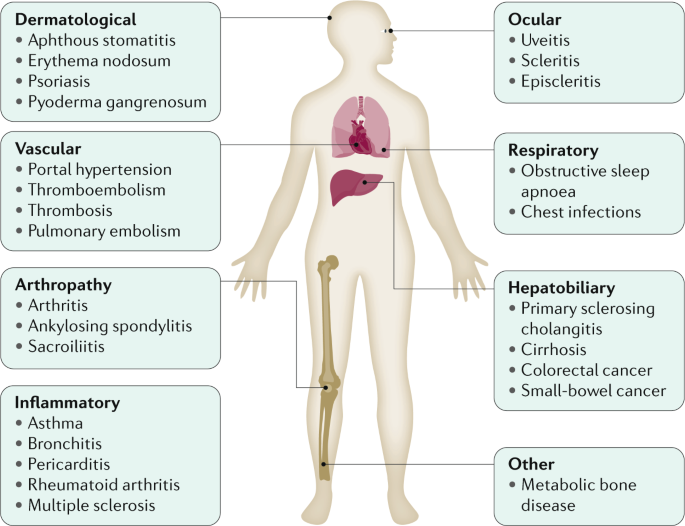 Crohn's disease  Nature Reviews Disease Primers
