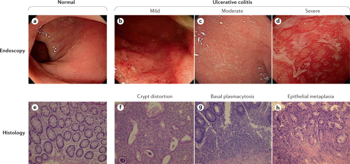 Ulcerative colitis  Nature Reviews Disease Primers