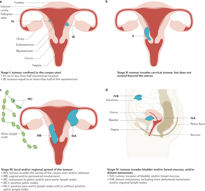 Closer Look at Postmenopausal Bleeding and Endometrial Cancer - NCI