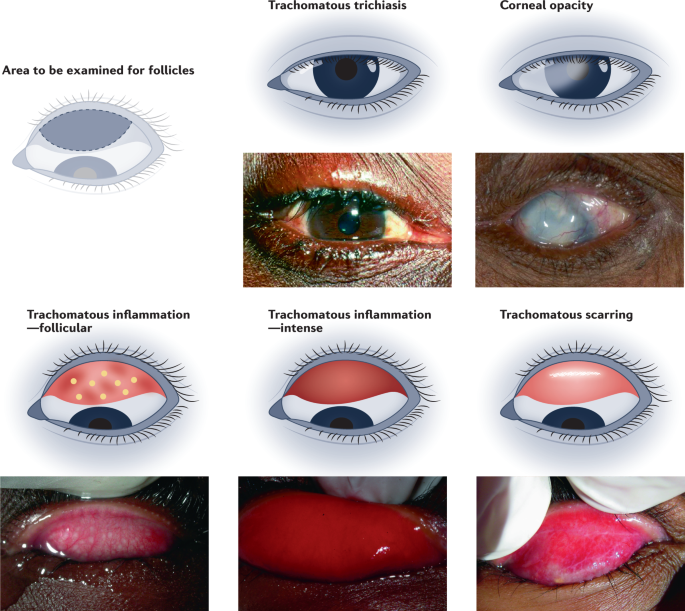 Surgical Management of the Giant Pannus: Indications, Strategies