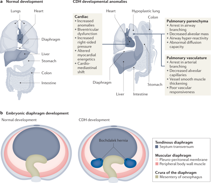 Congenital diaphragmatic hernia | Nature Reviews Disease Primers
