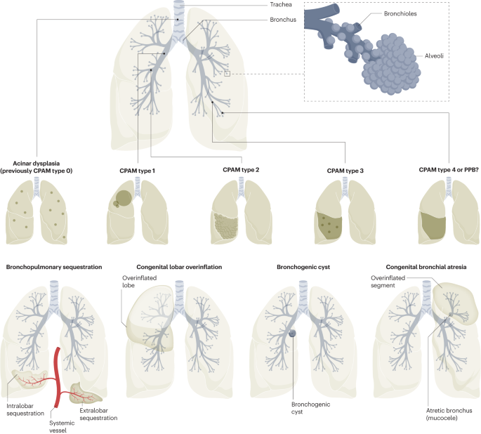 Overview of congenital respiratory malformations