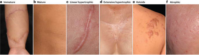 Open Wound Scar Adult Flesh Open Wound Scar Adult Flesh