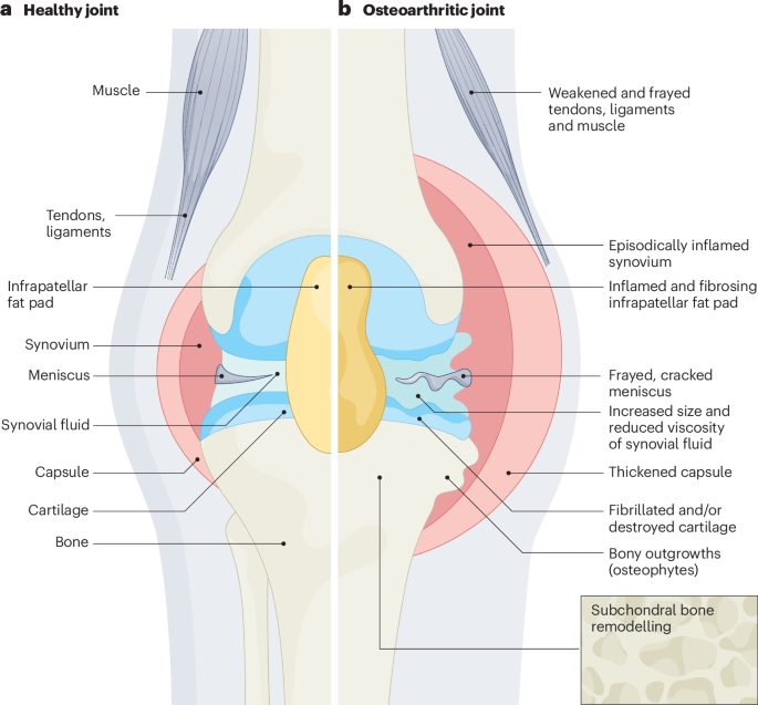 Global Surge in Osteoarthritis and Related Disabilities Over the Last 30 Years, According to Data