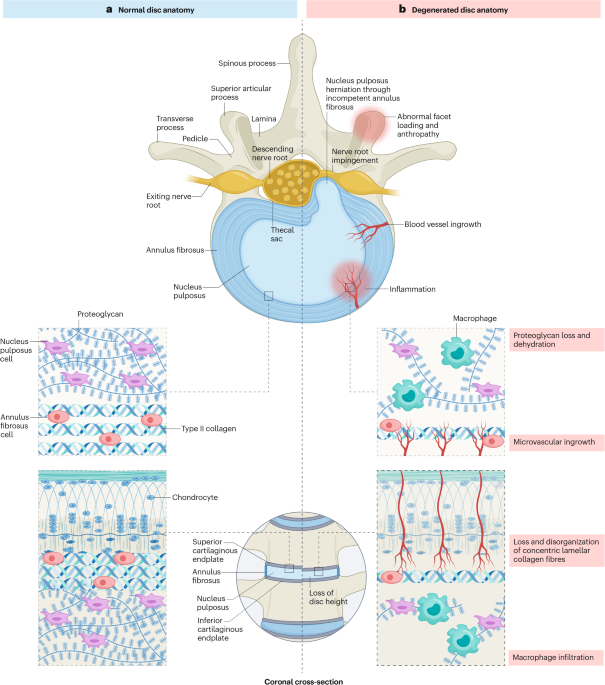 bpc-157 intervertebral disc degeneration study Intervertebral disc degeneration